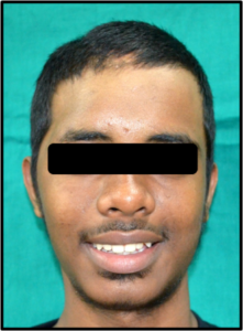 Cranial Prosthesis After