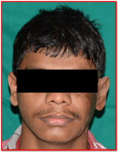 Ear Prosthesis After