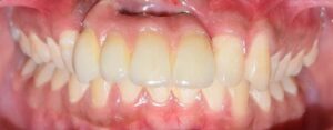 Implant Prosthesis After